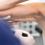 Op. Dr. Gökhan Semerci ile Kol Germe ve Uyluk Germe: Estetikte Yeni Dönem